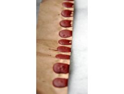 Çatapat Yutan Çocuğa Karaciğer Nakli Yapıldı