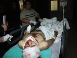 Bomba Patlayınca Eli Koptu