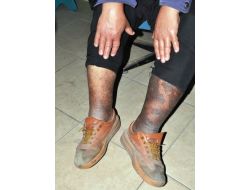 Yeşil Kartı İptal Edilen Hasta Yardım Bekliyor