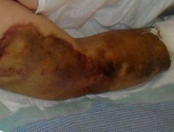 Karısının İki Ayağını Kırdı..