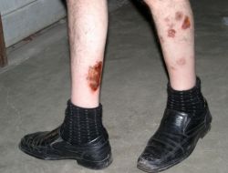 Şeker Hastasına Hem Çalışamazsın Diyorlar Hem De Yüzde 20 Rapor Veriyorlar