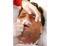 Uğur Acar’ın Yeni Hali Basına Gösterildi