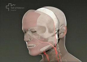 İkinci yüz nakli operasyonu