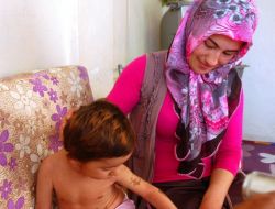 Vücudu Timsaha Benzeyen Çocuk İyileşti