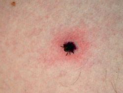 Erzincan Gıda Tarım Ve Hayvancılık Müdürlüğü'nden Kene Uyarısı