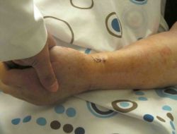 Kemik Erimesi, İlik İçi Çivi Yöntemi İle Korku Olmaktan Çıkıyor