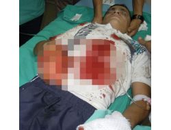 Polise Atmak İstediği El Bombası Elinde Patlayan Çocuk İki Parmağını Kaybetti