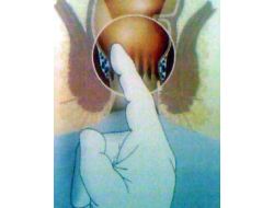 'Hemoroid’den Korunmak İçin Dar Çamaşır Giymeyin'