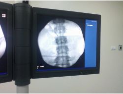 Baü Tıp Fakültesi'nde Bel Fıtığı Ameliyatsız Tedavi Ediliyor