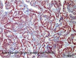 Manda Yoğurdu, Kalın Bağırsak Kanseri Riskini Yüzde 80 Önlüyor