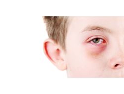 Uzmanlardan Alışveriş Merkezlerinde Göz Nezlesi Uyarısı