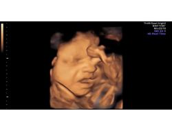 Anne Karnındaki Bebeğin Esnemesi Görüntülendi