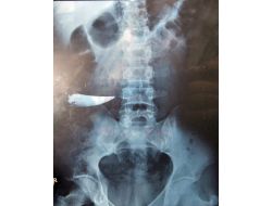 Karnında Unutulan Bıçakla 9 Yıl Yaşamış