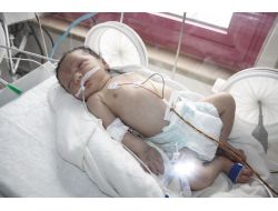 Doğumundan 10 Dakika Sonra Ameliyatla Kalp Kapakçığı Onarıldı