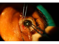 Gözünden 10 Santimlik Parazit Çıktı