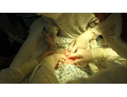 Rusya’da Başarılı Bir Operasyonla Ayrılan Siyam İkizleri Taburcu Oldu