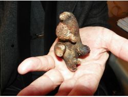 Böbreğinden At Nalı Tabir Edilen Taş Çıktı