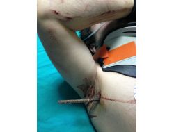 Göğsünü Delip Geçen Demirle Hastaneye Kaldırıldı