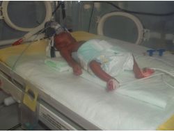 12 Gün Önce Dünyaya Gelen 560 Gramlık Parmak Bebek Hayata Tutundu