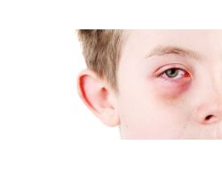 Uzmanlar Uyarıyor: Bahar, Alerji Yapmasın!