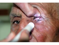 Şiş Ve Ağrı Var Diye Geldi, Gözünden Kene Çıkarıldı