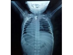 Yemek Borusuna Takılı Anahtar Parçası Bulundu