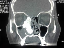Burun Kanalından Ceviz Büyüklüğünde Tümör Çıktı