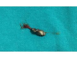 Polis Vurdu Denildi, Vücutlarında El Yapımı Bombanın Şarapnel Parçaları Çıktı