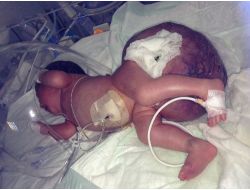 4 Kilo Doğan Bebekten 2 Kiloluk Kitle Alındı