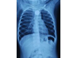 Minik Elif Yutulabilecek En Tehlikeli Şeyi Yuttu