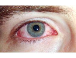 Uzmanlardan Bulaşıcı Hastalık Uyarısı: Elinizi Gözünüze Sürmeyin!