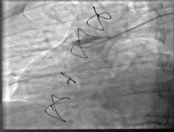 Damardaki Pıhtıyı Çeken Cihaz, Kalp Hastalarının Hayatını Kurtarıyor!.