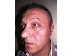 Çocuğuna Biyopsi Yapılmamasına Kızan Baba, Doktoru Darp Etti