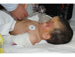 Üçüncü Kattan Düşerek Ağır Yaralanan Minik Kerem, Yoğun Bakımdan Çıktı