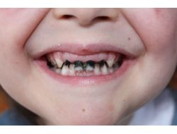 Çocuklarda Antibiyotik Kullanımı Diş Çürümesine Neden Oluyor