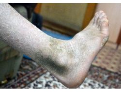 Balık Derili Kız, Sağlık Bakanı Mehmet Müezzinoğlu'ndan Yardım İstedi