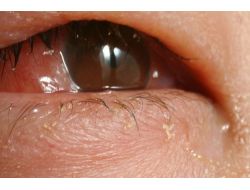 Havuz Suyu Göz Enfeksiyonlarına Neden Olabilir