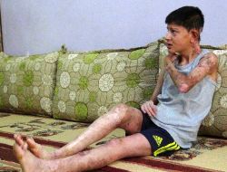 ´pamuk Prens´ Hastası Murat, Tedavi İçin Yardım Bekliyor