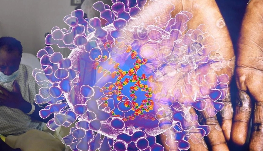 DSÖ: Maymun çiçeği virüsü eskisinden daha hızlı yayılıyor