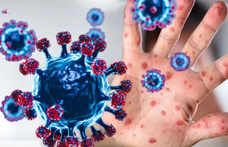 Sağlık Bakanlığı "M çiçeği" rehberini güncelledi