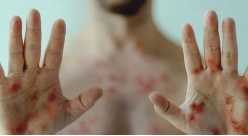 Fransa'dan, M çiçeği virüsünden etkilenen ülkelere 100 bin doz aşı sözü