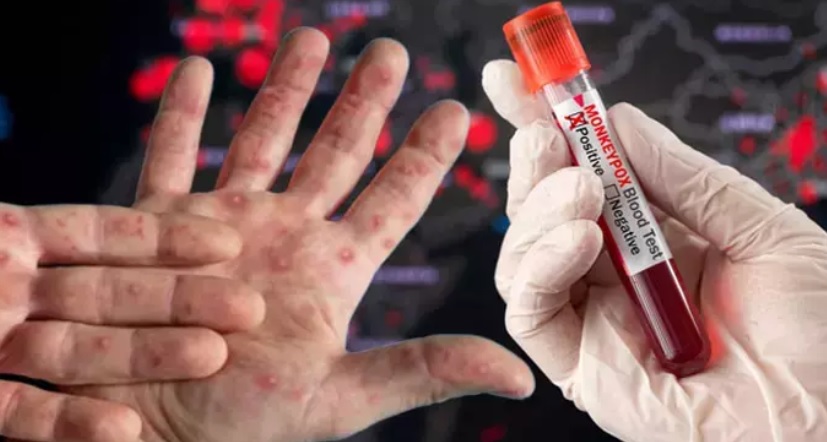 "Ankara'da 4 kişi, M çiçeği şüphesiyle karantinaya alındı" iddiası yalanlandı