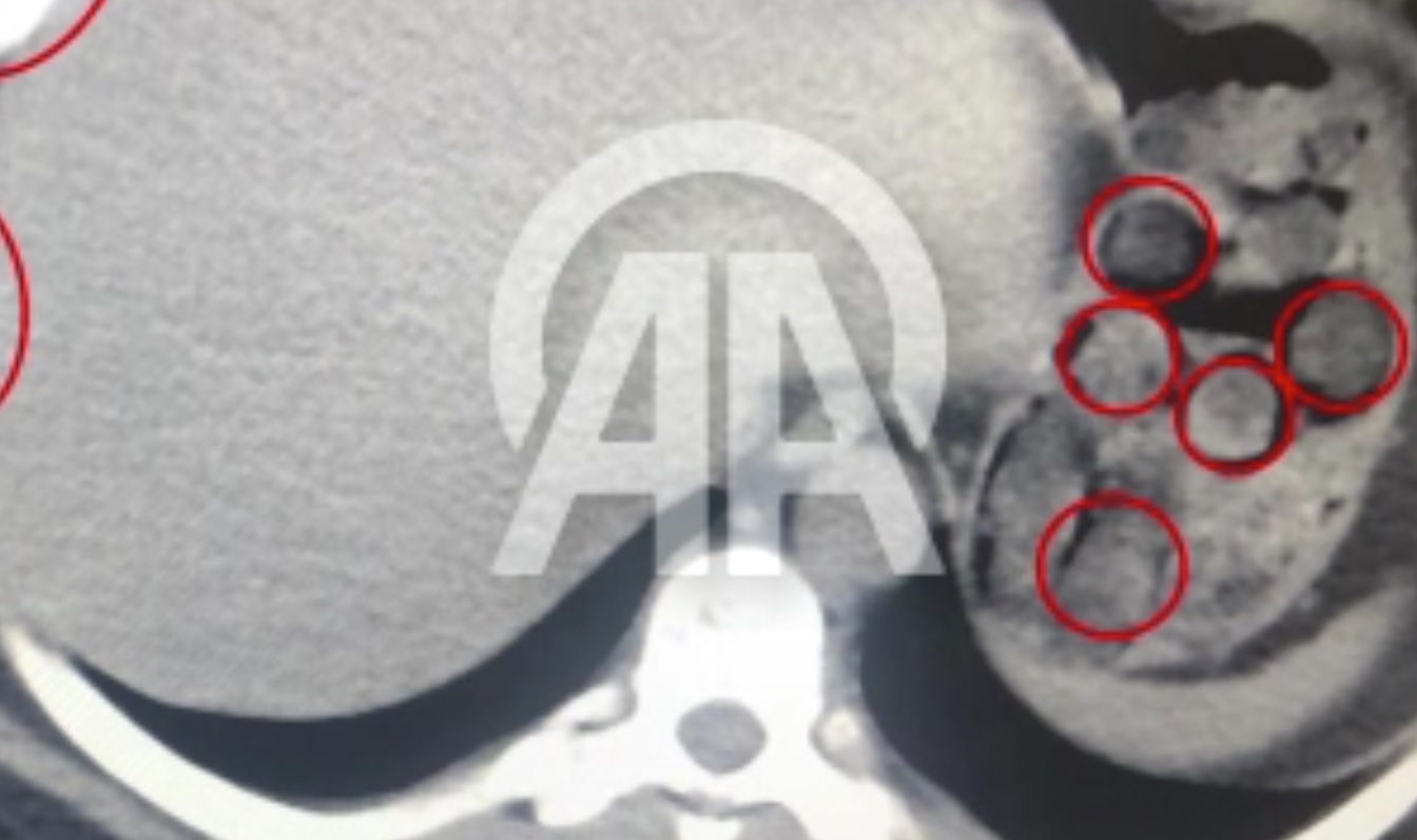 Mide ve bağırsaklarında uyuşturucu tespit edilen yabancı uyruklu 2 şüpheli tutuklandı