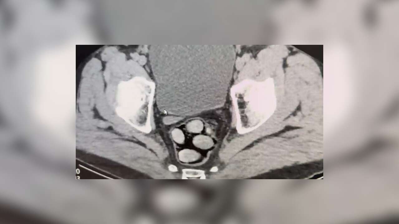 Batman'da şüphelinin midesinden 750 gram metamfetamin çıktı!