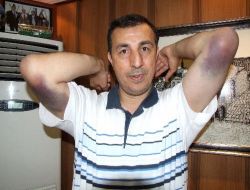 Demirbaş'ın Hastalığı Kollarına Sıçradı
