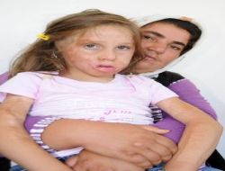 Okula Gidebilmesi İçin 30 Ameliyat Daha Olması Gerekiyor