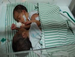 Endonezya'da Siyam İkizleri Dünyaya Geldi!