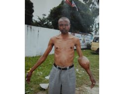 Kongolu Hastaya Adanalı Doktorlar Sahip Çıktı