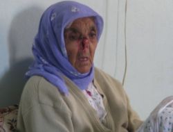 Sivilce Yüzünden Burnunu Kaybetti