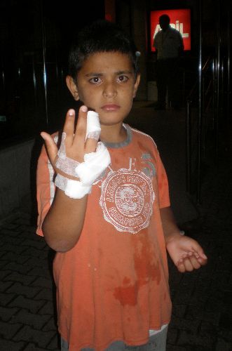 Kopan parmağını diktirmek için 5 hastane dolaştı..